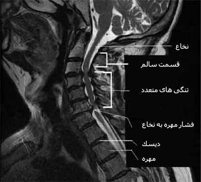 عکس تنگی کانال نخاعی