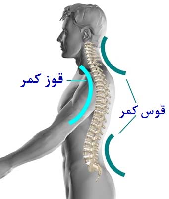 درمان گودی کمر چقدر طول میکشد