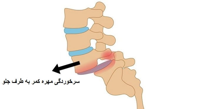 سرخوردگی مهره های کمر