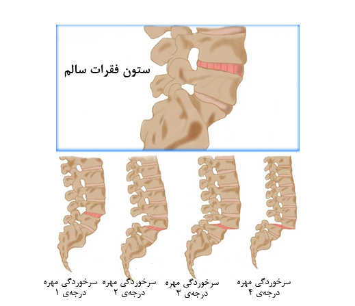 دلایل و علائم سرخوردگی ستون فقرات