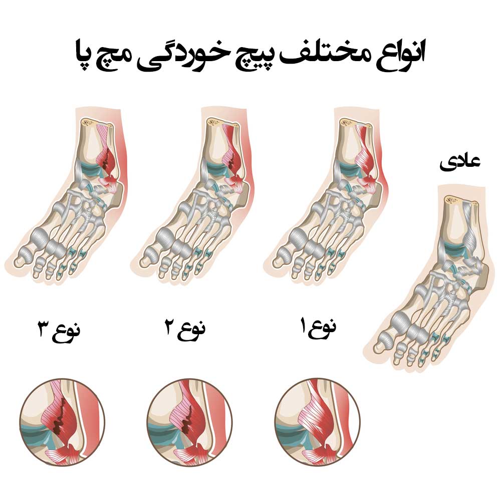 عکس پیچ خوردگی مچ پا 