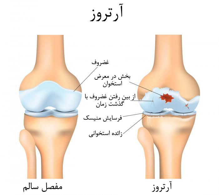 آرتروز زانو