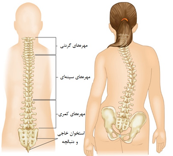 اسکولیوز چیست