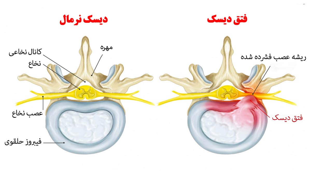 دیسک کمر