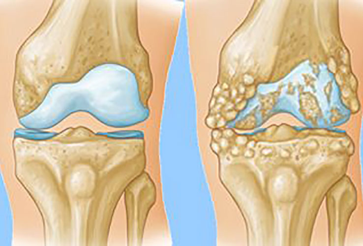 عکس آرتروز زانو