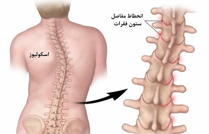 علت کج شدن بدن به سمت راست