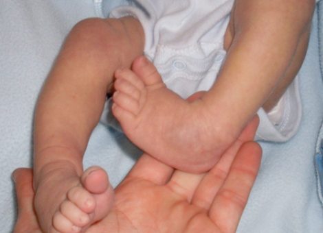 پا چنبری نوزاد