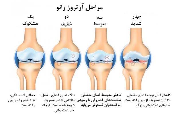 عکس آرتروز زانو