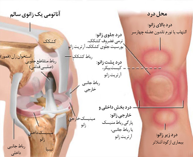 علت زانو درد 