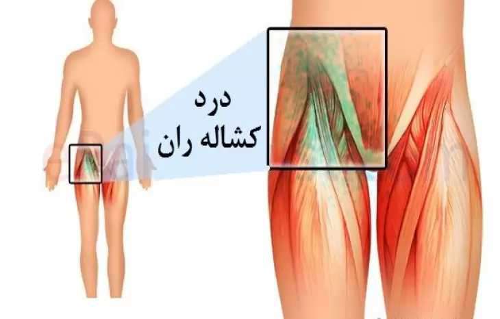 علت درد کشاله ران در زنان