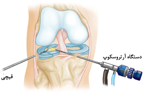 جراحی رباط پا