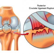 درمان کشیدگی و پارگی رباط زانو