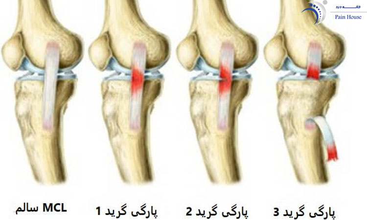 انواع پارگی رباط زانو