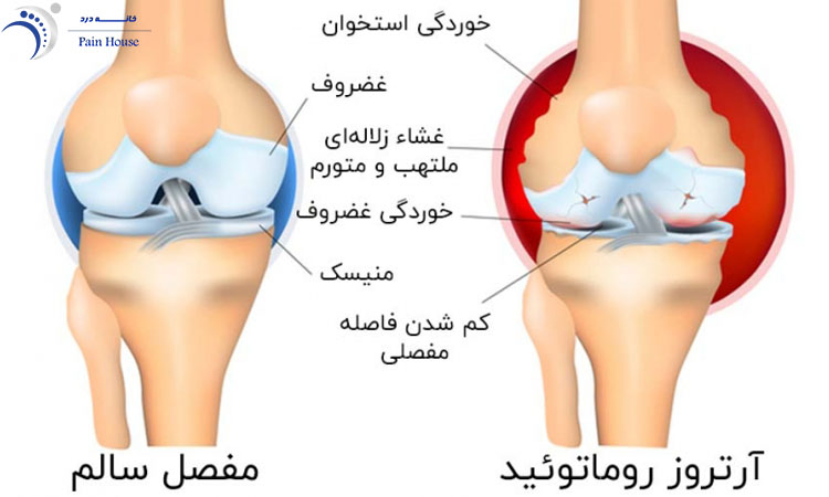 عکس آرتروز مفصل