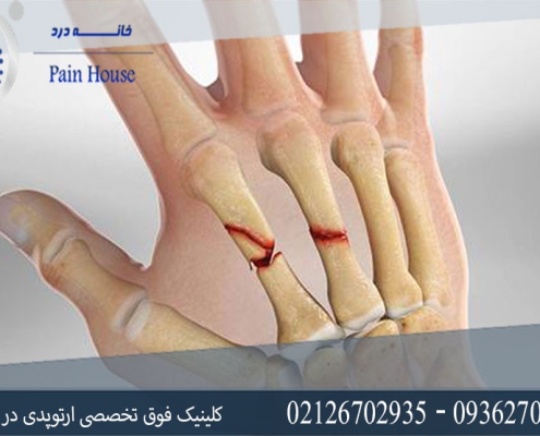 روش های درمان شکستگی استخوان کف دست چیست؟