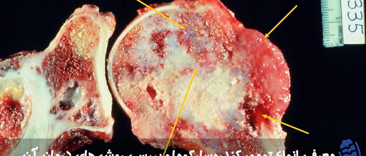 انواع تومور کندروسارکوما